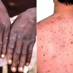 MonkeyPox can be controlled: WHO