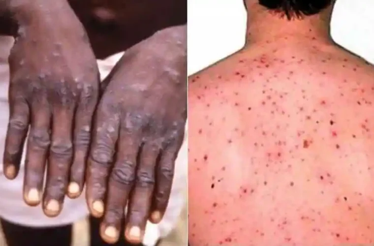 MonkeyPox can be controlled: WHO