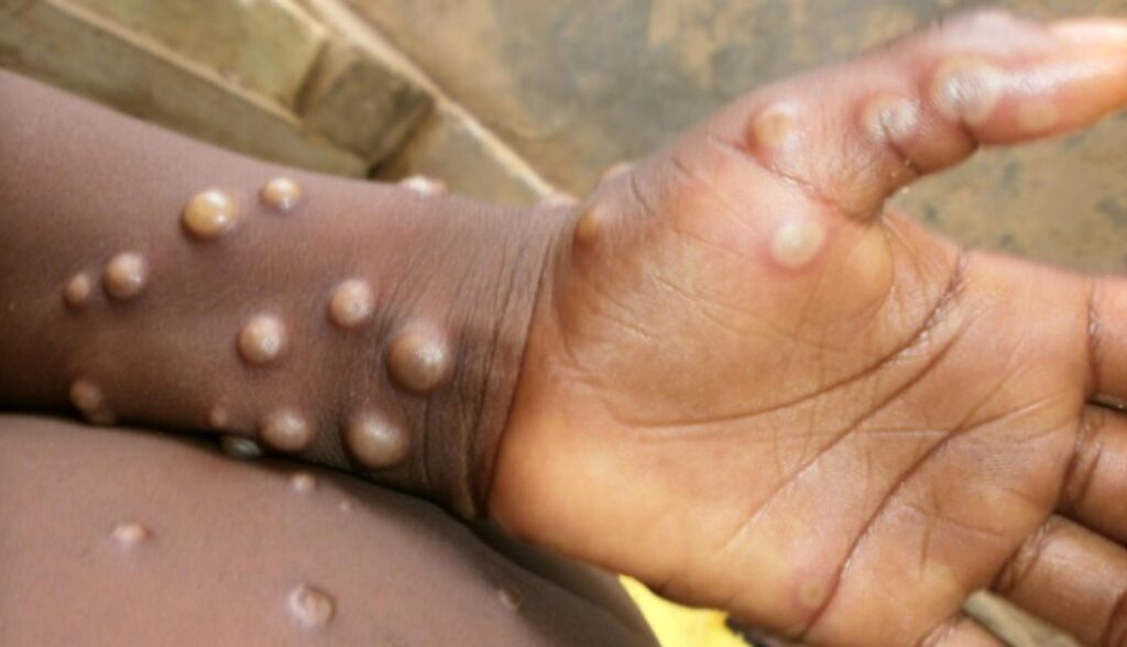 India reports sixth monkeypox case