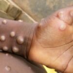 India reports sixth monkeypox case